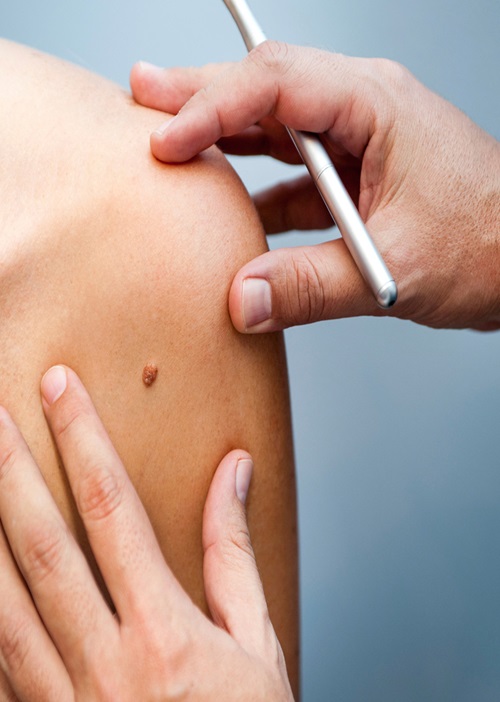 Skin Tag Removal