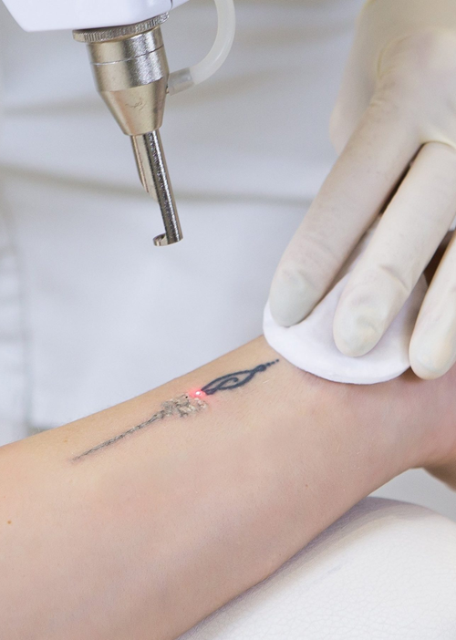 Tattoo Removal