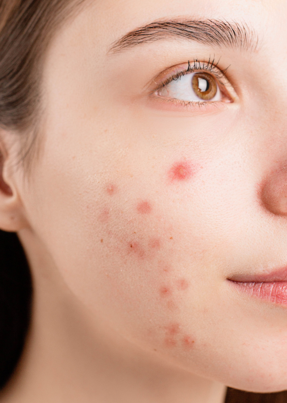 Acne & Acne Scar Treatments