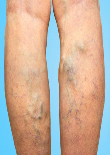 Benign Vascular Lesions and Leg Veins